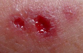 Wolf Spider Bite: What You Need To Do? - HubPages