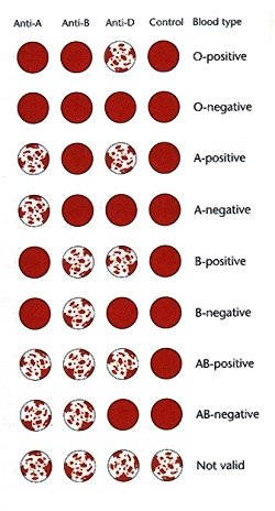 This chart demonstrates the standard ABO blood typing test results and each result's associated ABO and Rh D blood type.
