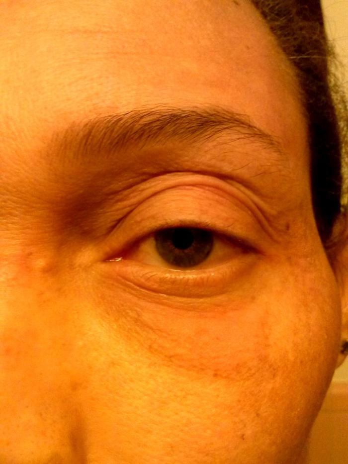 Rash frequently felt like the texture of alligator skin...very scaly. It often flaked off when severely dry.