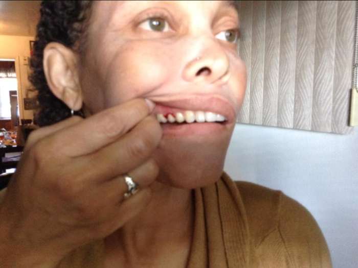 Sometimes my teeth randomly start to bleed. This is another reason for the frequent dental check-ups. I lost several teeth due to lupus, but managed to get it all under control using herbal remedies.
