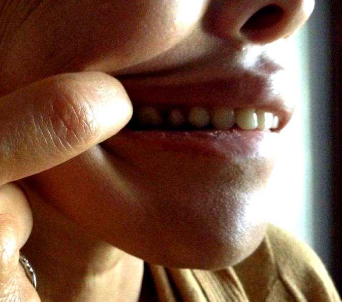 Some days my gums would spontaneously bleed. As a result of this, I have regular dental check-ups. I have already lost several teeth because of lupus, but have improved gum health. You will read about that later in another article.