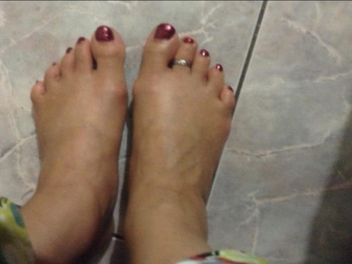 I have to be very careful of how long I am on my feet, as they get swollen very easily, and with neuropathy, I tend to lose feelings very often in my feet.