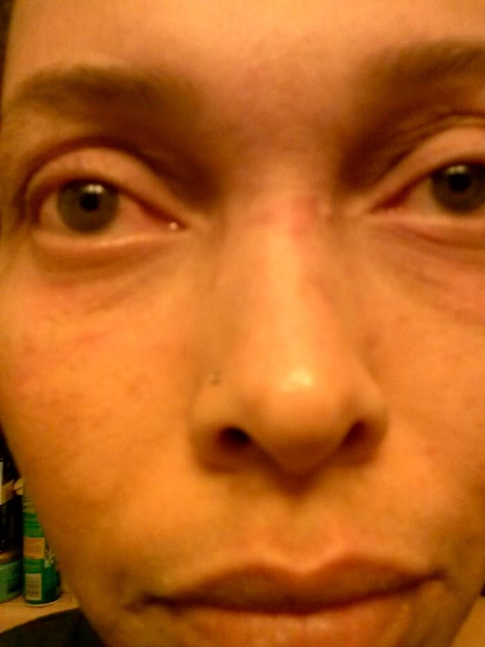 Full rash across the face, but also extended to above my lip as well as chin and neck area.