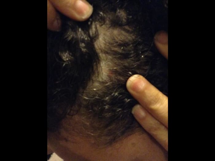Ulcers can also occur on the scalp causing hair loss. It resulted in my own hair falling out in patches.