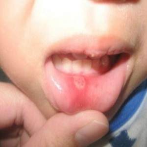 Oral ulcers frequently occur with lupus. I had to have more frequent dental check-ups as lupus started to affect my teeth.