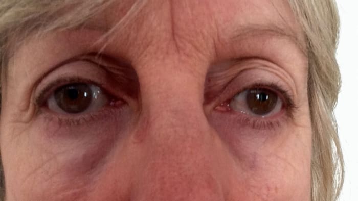 If you are looking at a reflection in the mirror, that looks older than you feel inside, maybe it is time to do something about those dark, under eye circles!