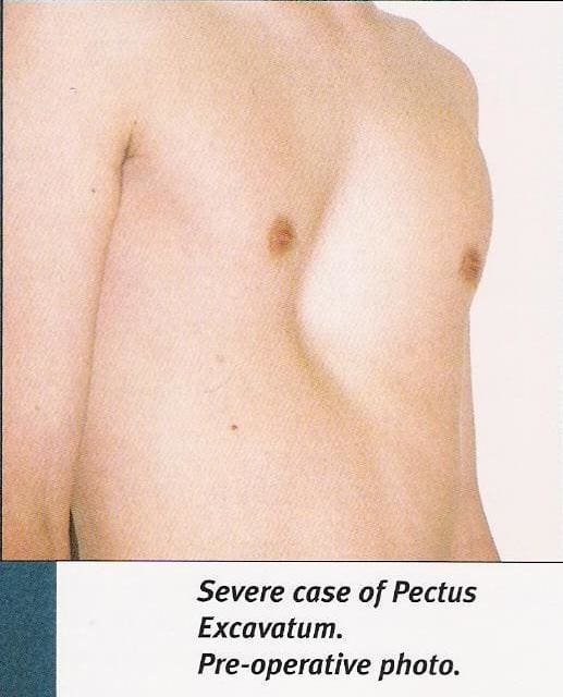 the caption below says severe but to be honest this level of P.E would be considered moderate at most but I'm sure proper medical exams may indicate differently, for example pressure on organs