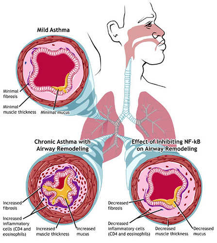 Asthma sufferers have trouble breathing because of the narrowing of the airways in their lungs, an example of which is shown in the upper left. In chronic asthma (lower left), repeated cycles of inflammation, damage, and repair lead to airway remodel