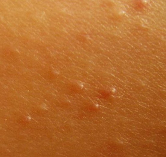 Keratosis Pilaris Pictures, Treatment, Symptoms and Causes HubPages