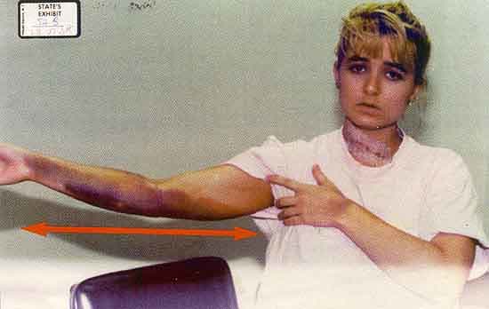 The supposed defensive bruise under Darlie's right arm that was not seen by one doctor or nurse in the hospital. This photo WAS SHOWN TO THE ENTIRE JURY, except to Charlie Samford. according to him.