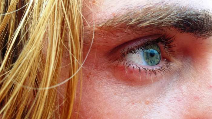 Ingrown Eyelashes or Trichiasis - HubPages