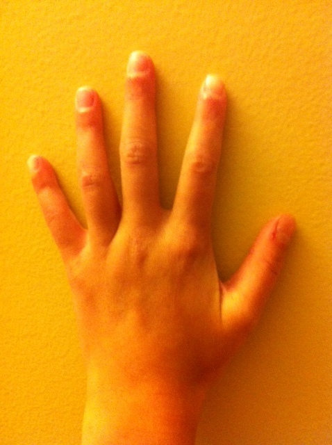 Mixed hand shape:round thumb, pointed index and forefinger, square ring finger, spatula pinky. Rare indeed.