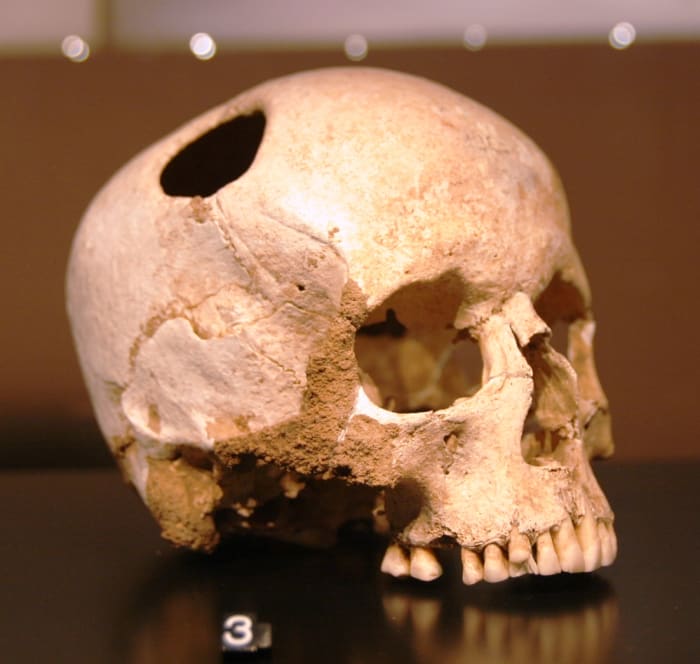 girl skull, trepanated with a silex; neolithic (3500 BC) ; patient survived. Natural History Museum, Lausanne