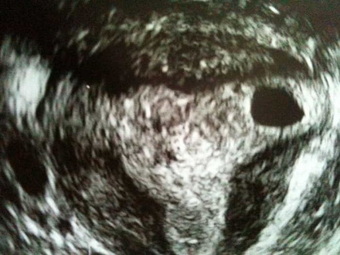 First scan of a blighted ovum at 7 weeks 4 days. The gestational sac only measured 5 weeks. The sac was near the fallopian tube but thankfully not ectopic.