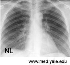This is what a healthy, normal chest X-ray looks like. Compare it to the one above with emphysema. See the difference?