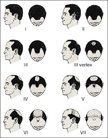 Norwood-Hamilton Scale of Male Pattern Baldness, published in Expert Reviews of Molecular Medicine by Cambridge University Press 2002- 2013 Hairstyles for Men with Balding Thinning Hair Style Cuts Trends by Rosie2010