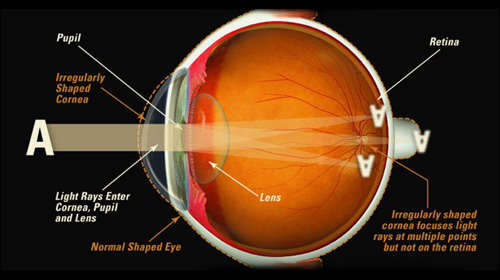 Light enters the eye through the cornea. It is refracted by the cornea and the lens onto the retina. From the retina, impulses are sent to the brain via the optic nerve.