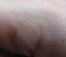 This is a photograph of my own pompholyx on my hand after optimising my immune system but without introducing iodine.