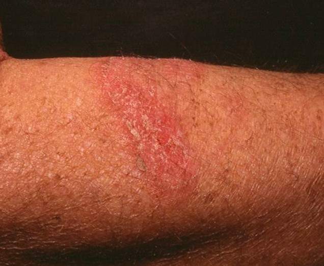 Mycosis fungoides essay 06 image