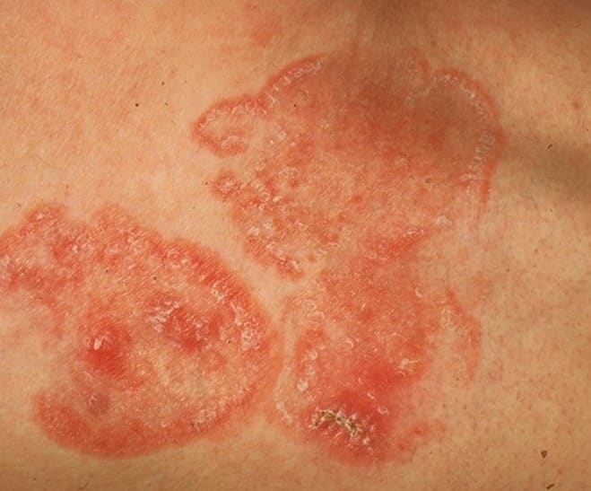 mycosis-fungoides-pictures-staging-symptoms-treatment-and-causes