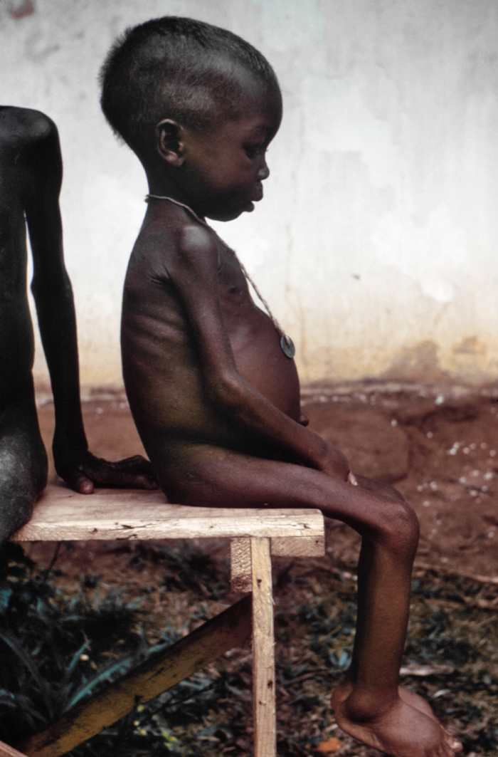 The body weight is less than 60% of the normal. Dependent edema is present. Mental changes, skin and hair changes and hepatomegaly are evident.