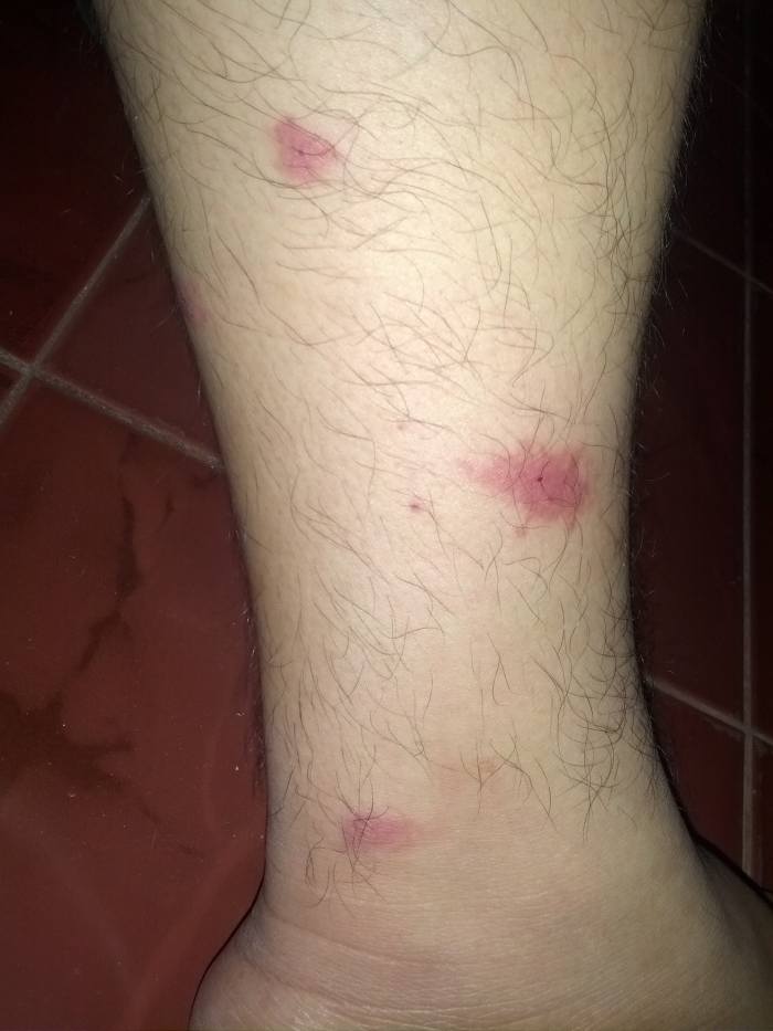 Several mosquito bites on a leg that have been scratched and inflamed.
