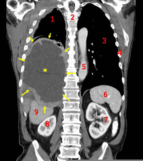 Malignant Mesothelioma, coronal CT scan. Legend: the malignant mesothelioma is indicated by yellow arrows, the central pleural effusion is marked with a yellow star. (1) right lung, (2) spine, (3) left lung, (4) ribs, (5) aorta, (6) spleen, (7) left
