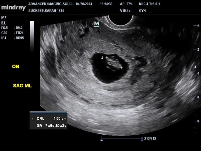 The empty sac on the right side indicates a twin that didn't make it past the embryonic stage. See the blood in the lower half of the sac.