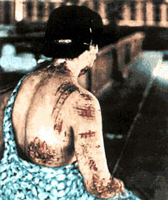 The energy released by the bomb was powerful enough to burn through clothing. The dark portions of the garments this victim wore at the time of the blast were emblazoned on to the flesh as scars, while skin underneath the lighter parts (which absorb