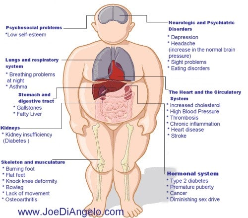 Anatomical clip art figure of an obese man detailing the various diseases that weight and inactivity can cause to the human body