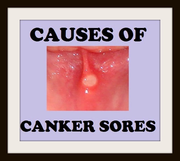 Common Causes of Canker Sores - HubPages