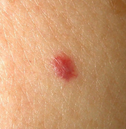 Cherry Angiomas - Pictures, Symptoms, Causes, Treatment, Removal - HubPages