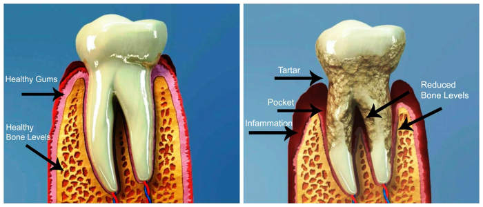 Healthy tooth with healthy gum and bone levels compared with moderate periodontitis. Teeth begin to loosen as the bone levels erode.