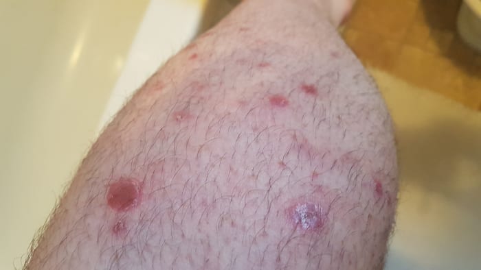 Psoriasis spots all down my leg. They get worse in the winter, when skin is covered from the sunlight.