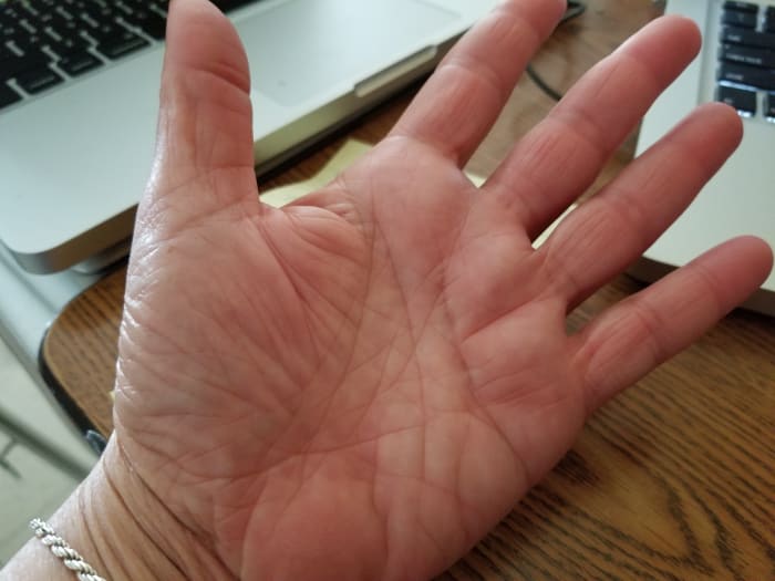 Full recovery. A photo at the two year mark. Full use of my hands, no recurrence of CTS symptoms.