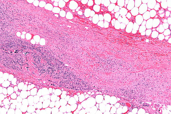 In this example of necrotizing fasciitis, the tissue in the middle has undergone necrosis (tissue death). This is why the cells are no longer visible.