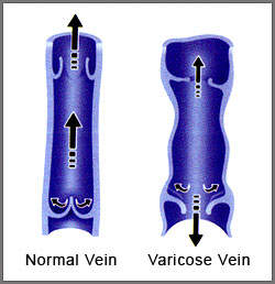 If the valves are incompetent, they no longer meet & thus can no longer catch the “backflow" of blood between heartbeats.