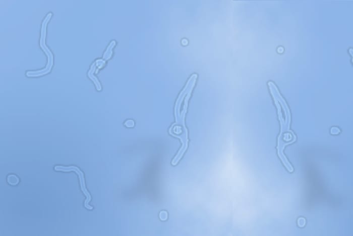 When the vitreous detaches, loose cells float around and look like thread-like strands. We call these "floaters."
