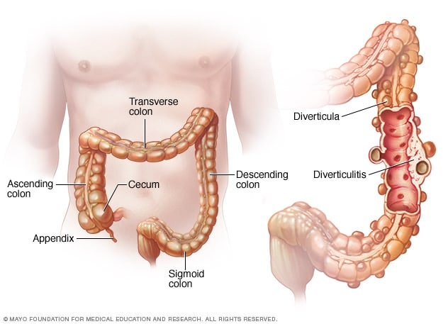 facts-about-diverticulitis-and-diverticulosis-youmemindbody