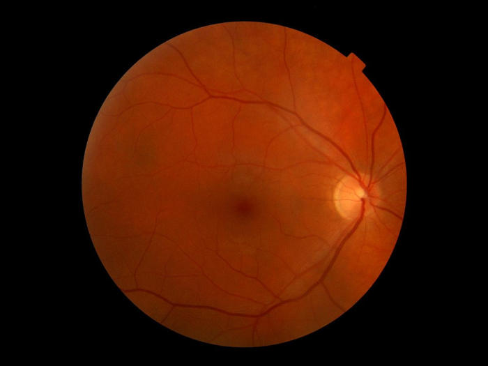 Human eye. The light circle is where the optic nerve exits the retina.