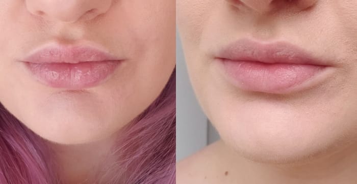 As you can see in the left photo, my lips were looking ROUGH. The right photo was taken literally one day after.