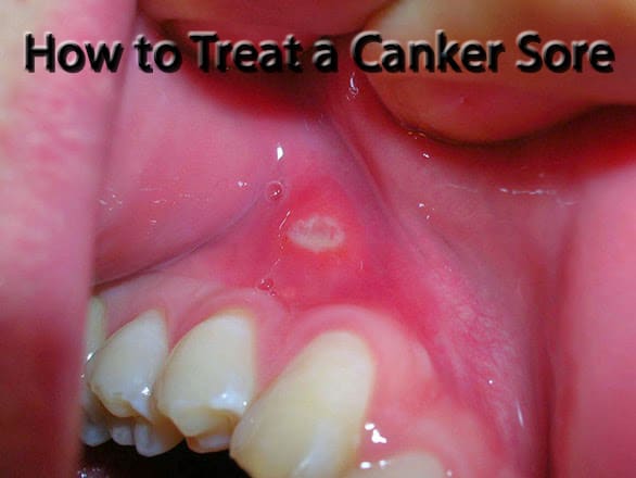 A sore in the mouth can be mildly irritating or downright painful. Get rid of the canker sore quickly with these tricks.