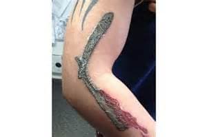 Scabbing on a tattoo. It appears the skin is having a major reaction to the ink used. This tattoo will in all likeliness have substantial damage.