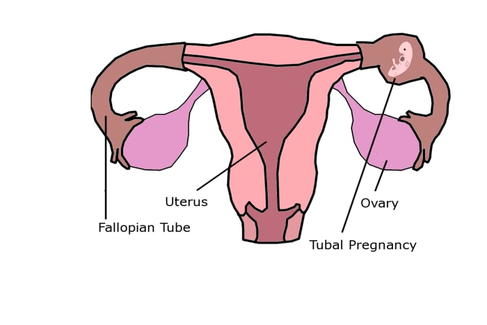 When an embryo implants in the Fallopian tube, the pregnancy is not viable and threatens the life of the mother.