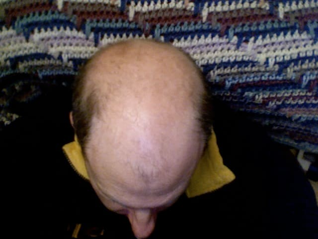 Men deal with hair loss more frequently than women.