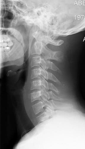 Cervical Spine with straightening of normal curve due to muscle spasms after motor vehicle accident. Creative Commons, Flickr.com.