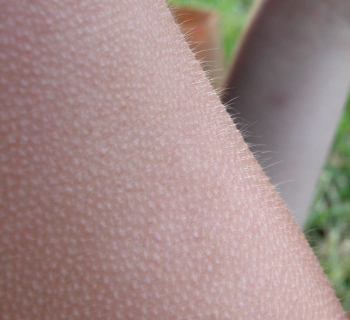 Some sceptics claim that ASMR is nothing more than goosebumps.