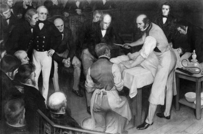 This 1912 painting by Ernest Board depicts Robert Liston about to amputate a patient’s leg before an admiring crowd.