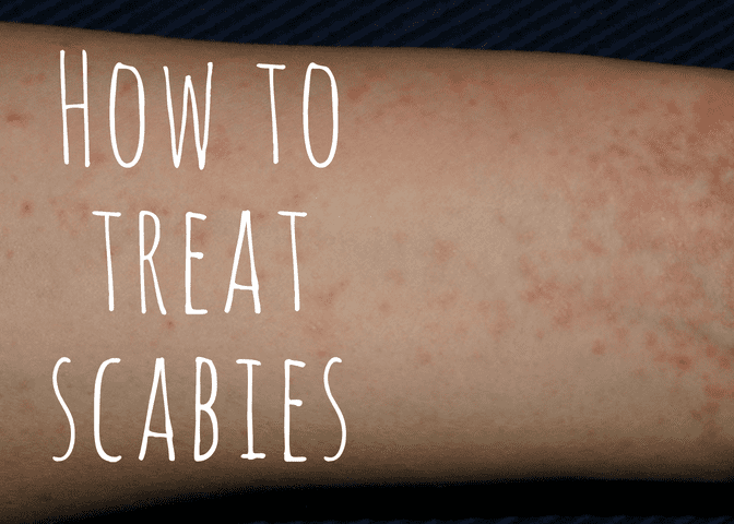 Top Over-the-Counter Scabies Treatments & Prescription Medications ...