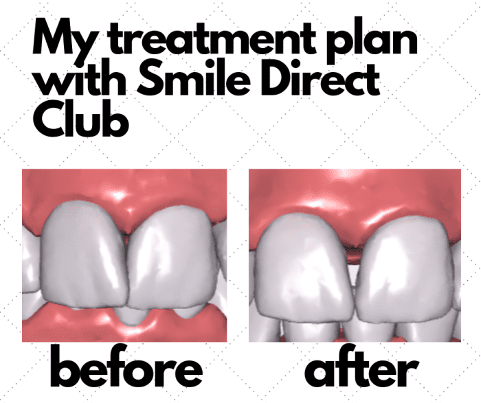 I was disappointed with the treatment plan Smile Direct Club designed for me. My "after" had a large gap they deemed unavoidable.